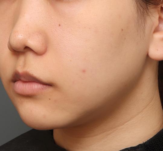 20代女性のシミ・そばかす Before 症例写真