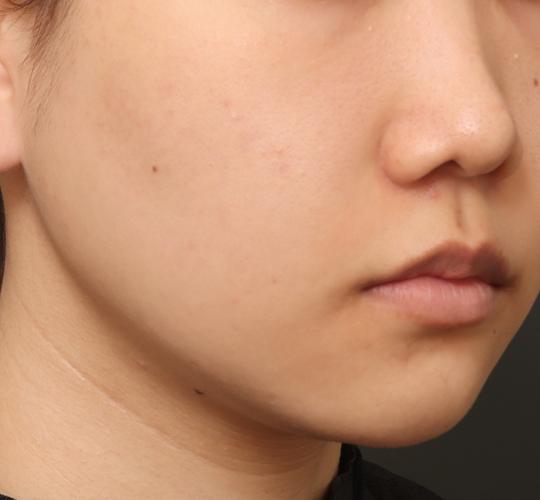 20代女性のクラリティフォトフェイシャルプラス Before 症例写真