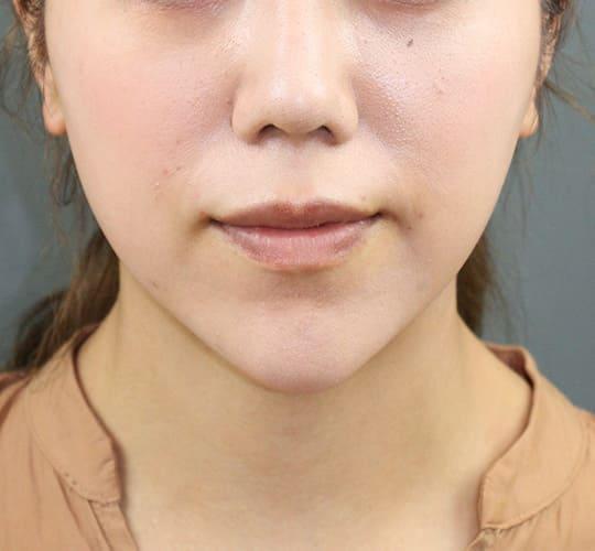 30代女性の人中短縮ボトックス After 症例写真