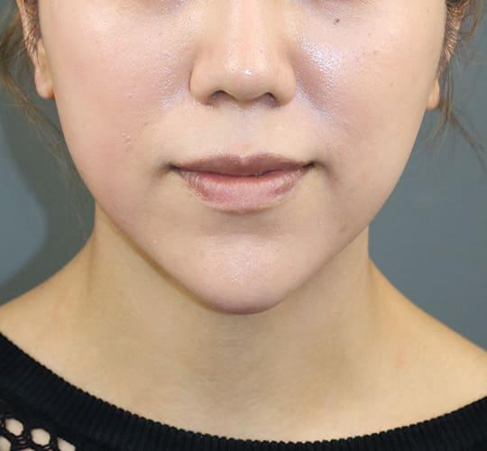 30代女性の人中短縮ボトックス Before 症例写真