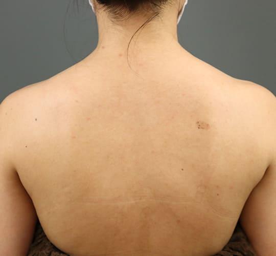 20代女性のボトックス（美肩・肩こり解消） After 症例写真