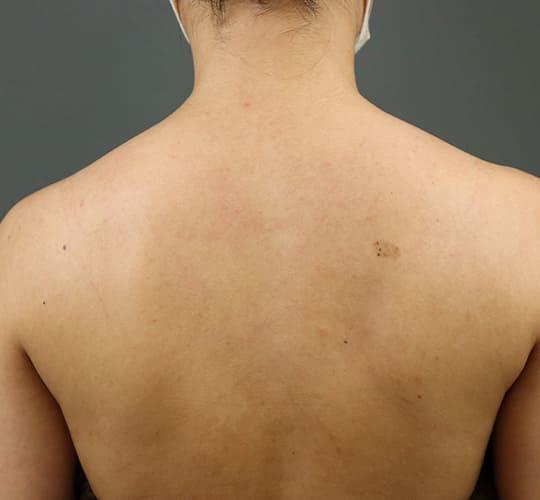 20代女性のボトックス（美肩・肩こり解消） Before 症例写真