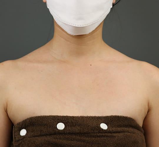 20代女性のボトックス(美肩・肩こり解消) After 症例写真