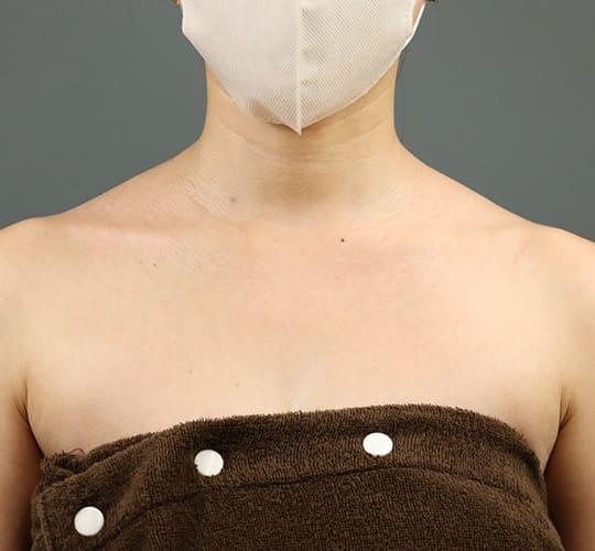 20代女性のボトックス(美肩・肩こり解消) Before 症例写真