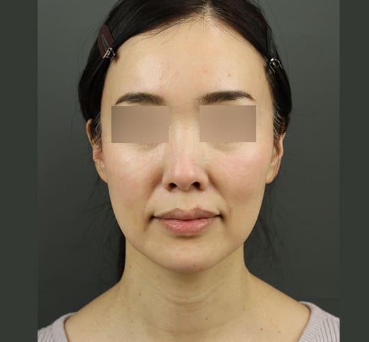 40代女性のVOVリフトプレミアム After 症例写真