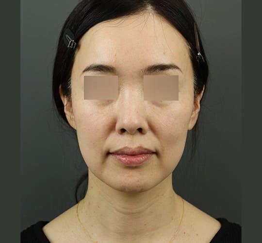 40代女性のVOVリフトプレミアム Before 症例写真