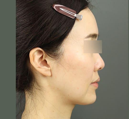 40代女性のVOVリフトプレミアム After 症例写真