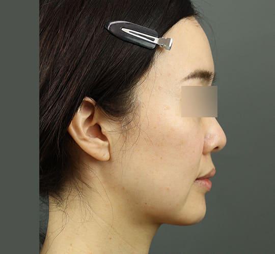 40代女性のVOVリフトプレミアム Before 症例写真