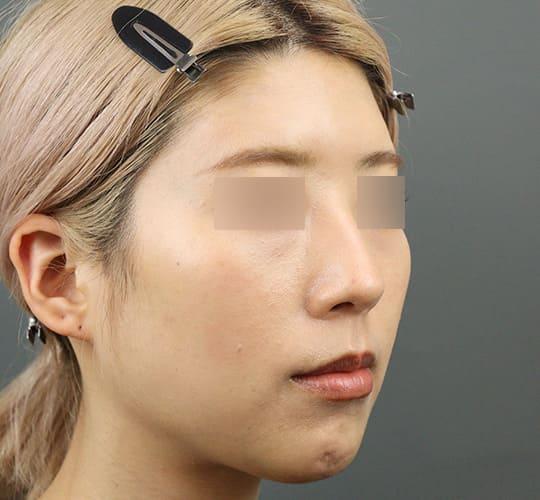 30代女性のヒアルロン酸注射（額） After 症例写真