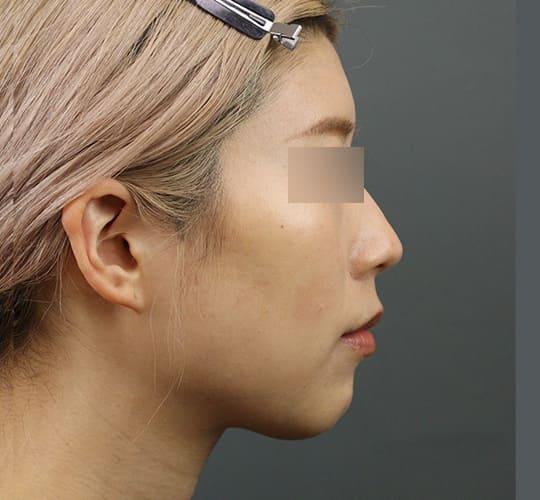 30代女性のエラ・アゴ・小顔 After 症例写真