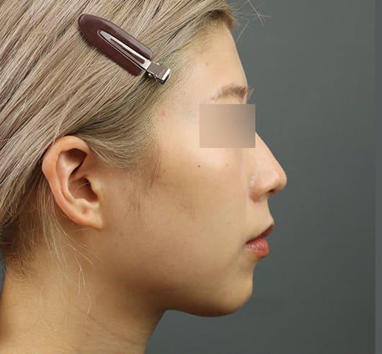 30代女性のエラ・アゴ・小顔 Before 症例写真