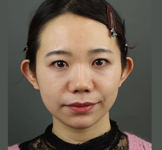 20代女性のエラ・アゴ・小顔 After 症例写真