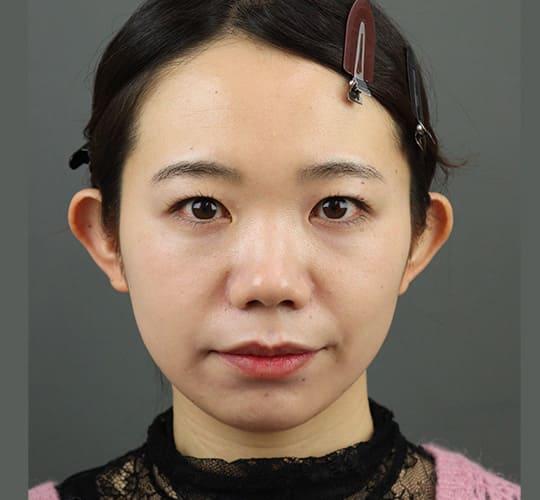 20代女性のエラ・アゴ・小顔 Before 症例写真