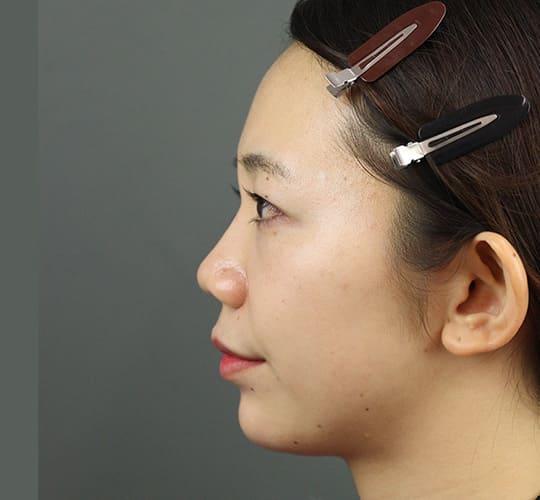 20代女性のヒアルロン酸注射(鼻形成) After 症例写真