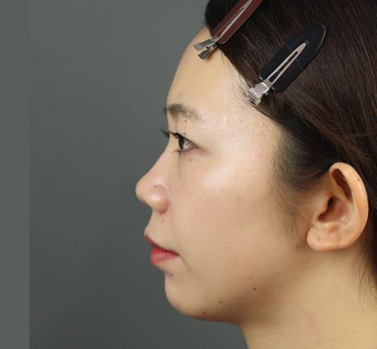 20代女性のヒアルロン酸注射(鼻形成) Before 症例写真