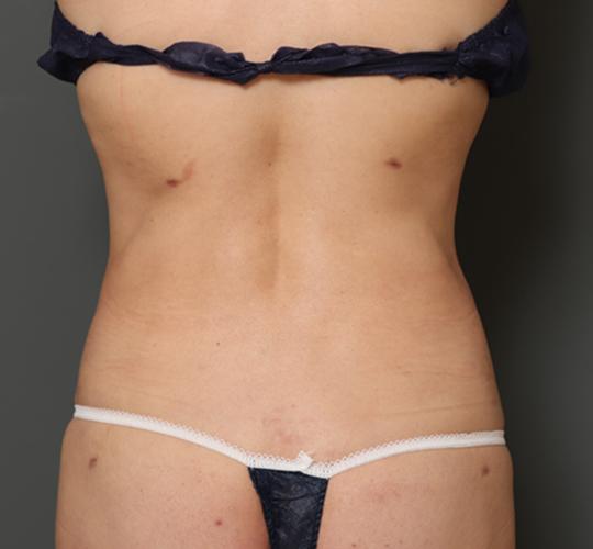 50代女性の脂肪吸引 After 症例写真