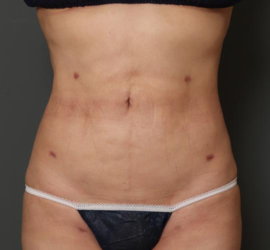 50代女性の脂肪吸引 After 症例写真