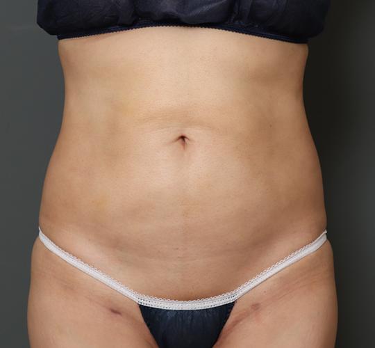 50代女性の脂肪吸引 Before 症例写真