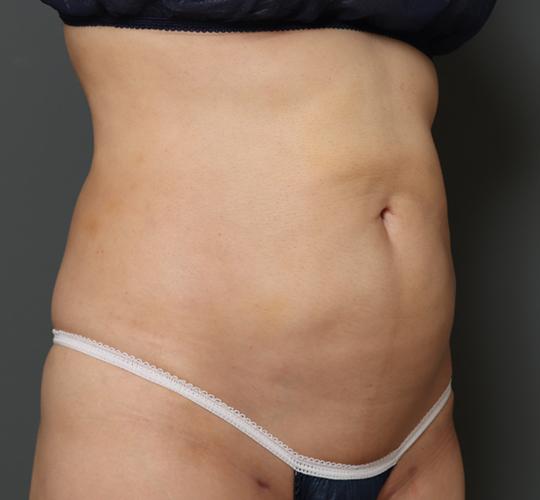50代女性の脂肪吸引 Before 症例写真