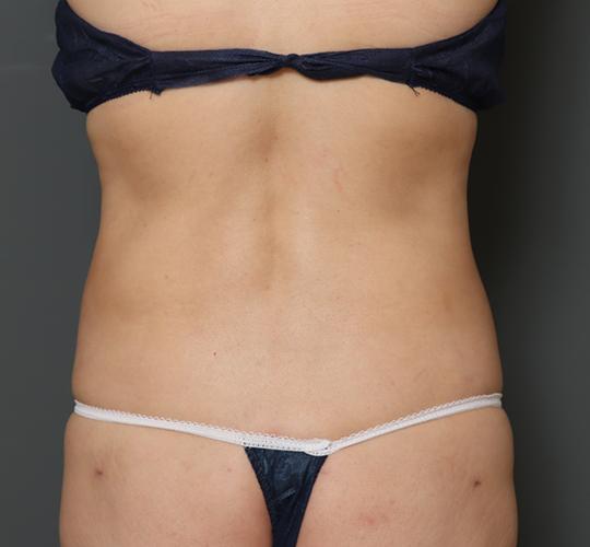 50代女性の脂肪吸引 Before 症例写真