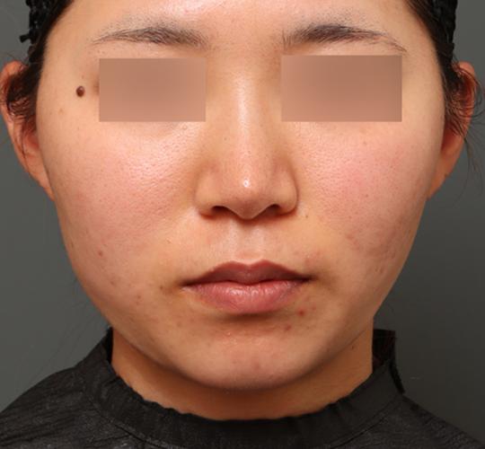 20代女性の二重アゴ筋肉縛り（ペリカン手術） After 症例写真