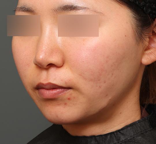 20代女性の二重アゴ筋肉縛り（ペリカン手術） After 症例写真