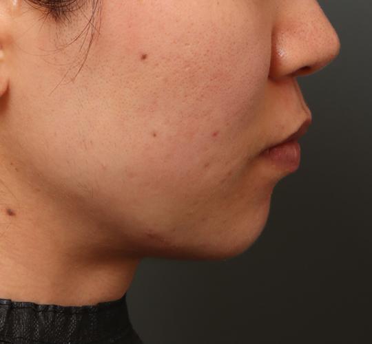 20代女性のエラ・アゴ・小顔 After 症例写真