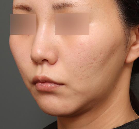 30代女性の脂肪吸引・痩身 After 症例写真