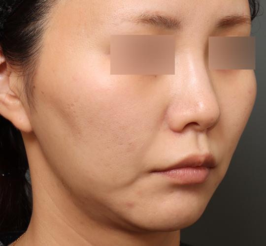 30代女性のフェイスタイト After 症例写真