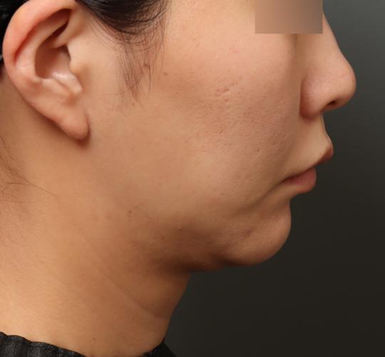 30代女性のフェイスタイト After 症例写真