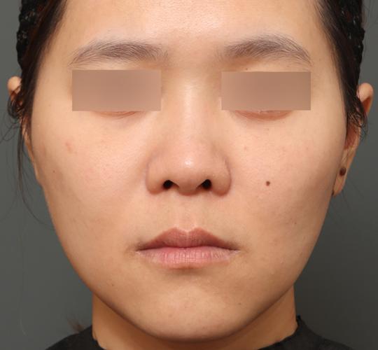 30代女性の3Dリポアイリフト  After 症例写真