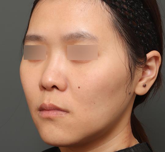 30代女性の3Dリポアイリフト  After 症例写真