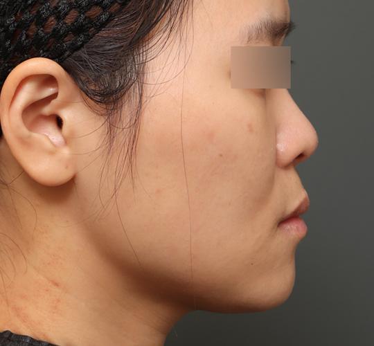 30代女性の3Dリポアイリフト  After 症例写真