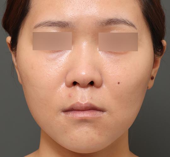 30代女性の3Dリポアイリフト  Before 症例写真