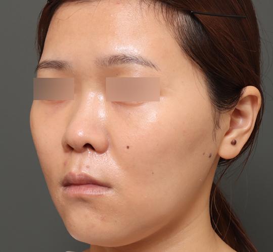 30代女性の3Dリポアイリフト  Before 症例写真