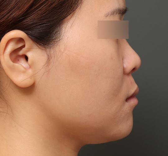 30代女性の3Dリポアイリフト  Before 症例写真