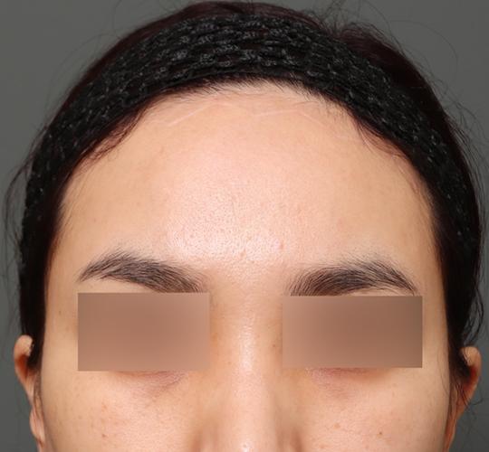 30代女性のエラ・アゴ・小顔 After 症例写真