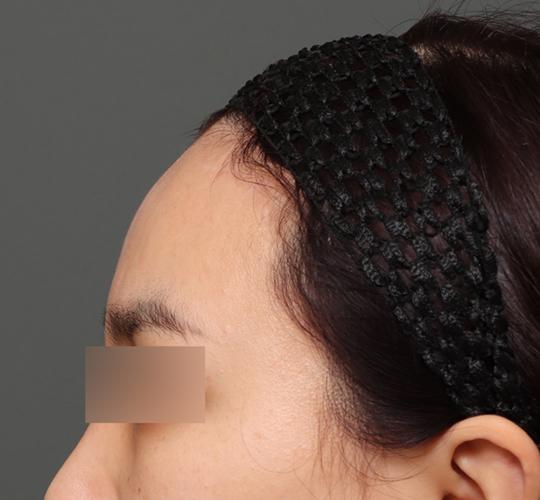 30代女性の額縮小 After 症例写真