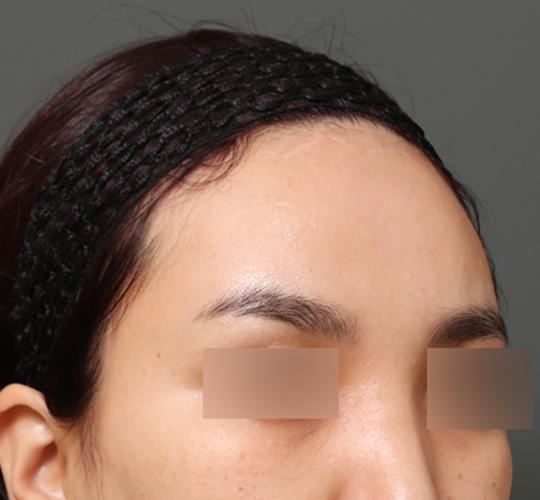 30代女性の額縮小 After 症例写真