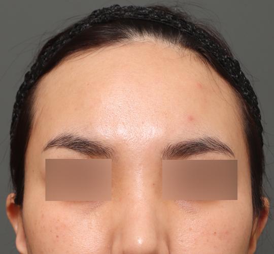 30代女性のエラ・アゴ・小顔 Before 症例写真