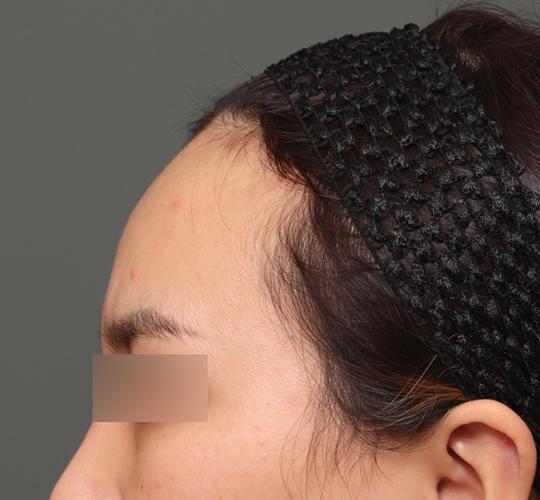 30代女性の額縮小 Before 症例写真