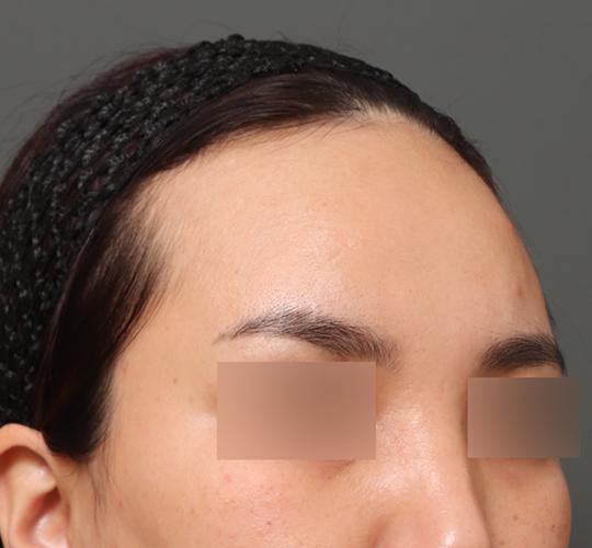 30代女性の額縮小 Before 症例写真