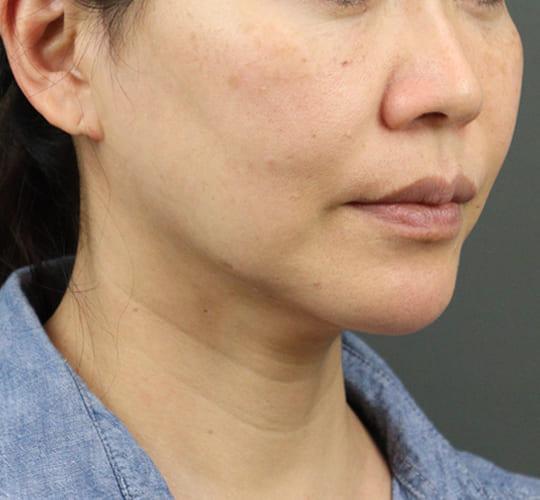 40代女性のVOVリフトプレミアム After 症例写真