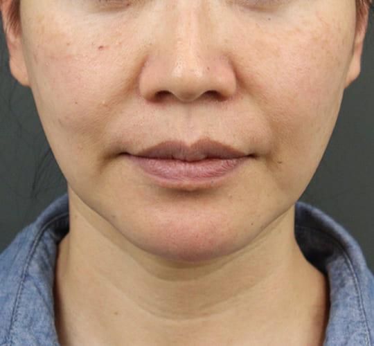 40代女性のVOVリフトプレミアム After 症例写真