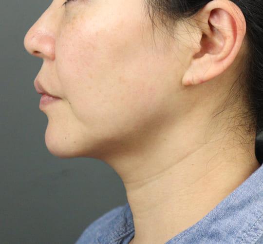 40代女性のエラ・アゴ・小顔 After 症例写真