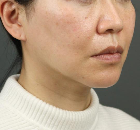 40代女性のVOVリフトプレミアム Before 症例写真