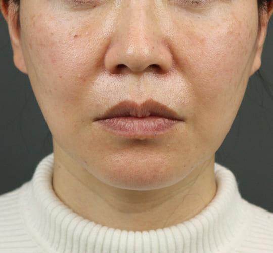 40代女性のVOVリフトプレミアム Before 症例写真