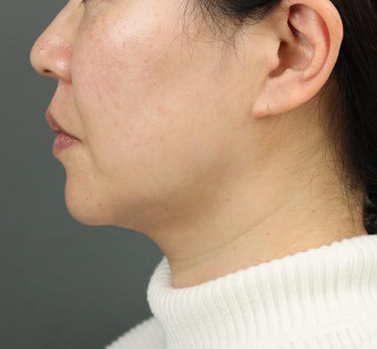40代女性のエラ・アゴ・小顔 Before 症例写真