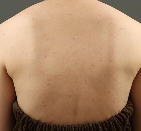 30代女性の美肌治療 After 症例写真