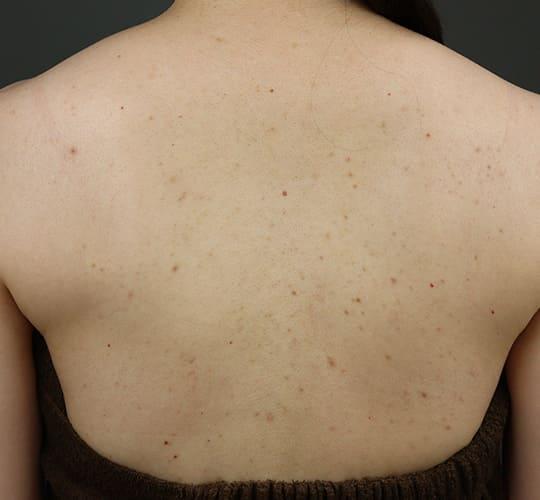 30代女性の美肌治療 Before 症例写真